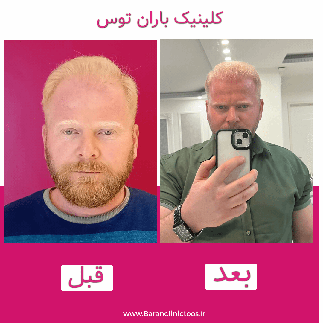 قبل و بعد کاشت مو